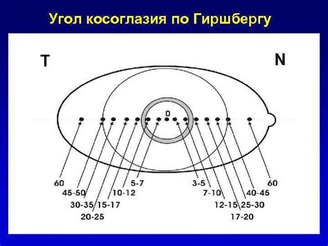 Значение угла девиации по Гиршбергу 0 градусов