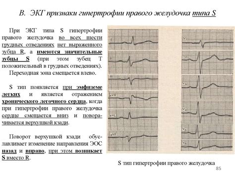 Значение умеренных изменений миокарда левого желудочка на ЭКГ