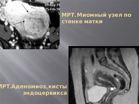 Значение эндоцервикса 1мм