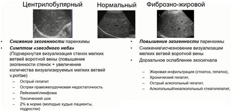 Значение эхоструктуры печени