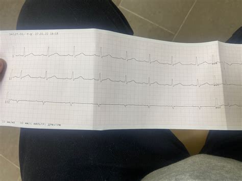 Значения отклонения параметров QRS