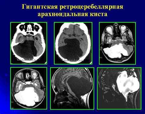 Значения ретроцеребеллярной арахноидальной кисты у ребенка