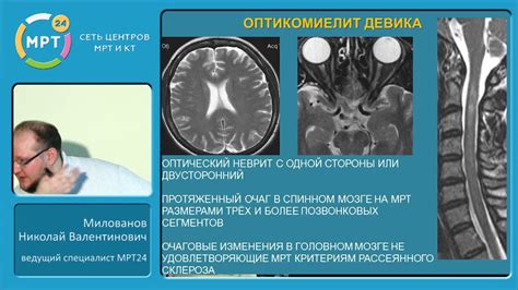 Значимость отсутствия очаговых изменений