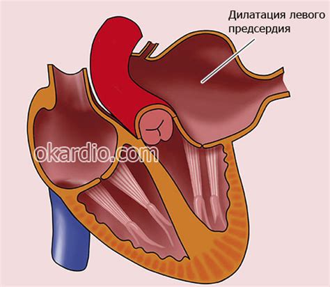 Изменение миокарда левого предсердия: причины, симптомы, лечение