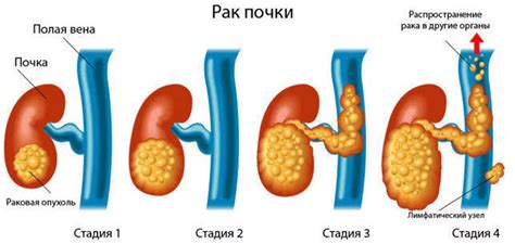 Изменение образа жизни после удаления почки