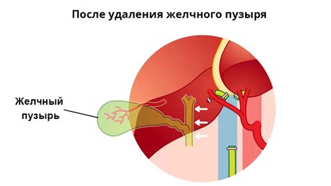 Изменения в обработке жиров после удаления желчного пузыря