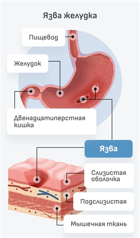 Изъязвленная язва желудка или двенадцатиперстной кишки