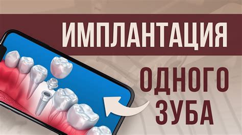 Имплантация зуба: современный метод восстановления утраченного коренного зуба