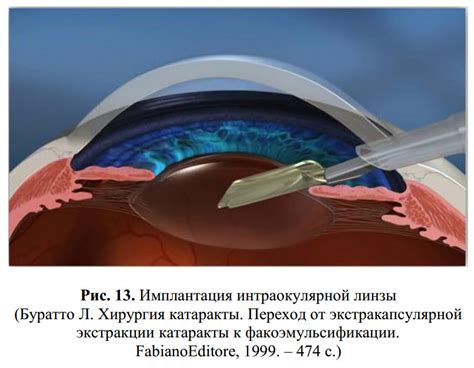 Имплантация факической интраокулярной линзы