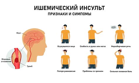 Инсульт: причины, симптомы, лечение