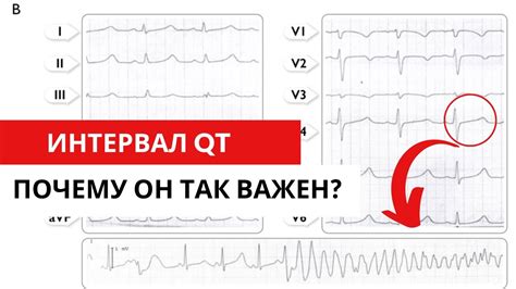 Интервал QT на ЭКГ: какие сведения он даёт о работе сердца