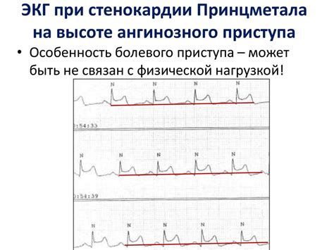 Интерпретация ЭКГ НБПНПГ: ключевые термины и их значение