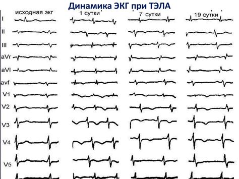 Интерпретация ЭКГ при полувертикальном положении