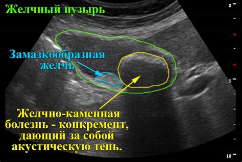 Интерпретация результатов УЗИ желчного пузыря с нагрузкой