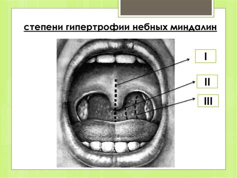 Инфекции глоточной миндалины