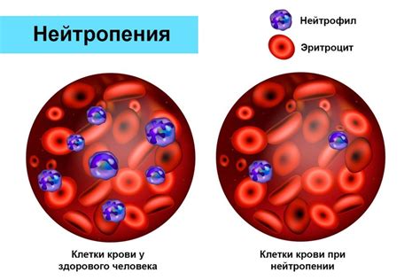 Инфекционные заболевания и понижение уровня нейтрофилов