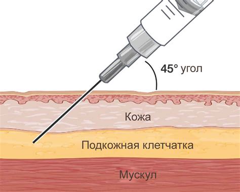 Инъекция под кожу: как происходит процедура и сколько она занимает времени