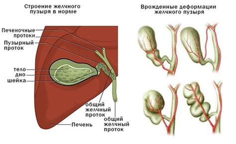 Искривление желчного пузыря