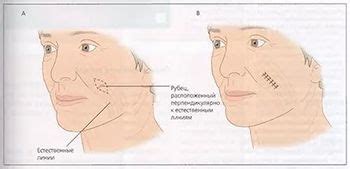 Иссечение рубцов: основные понятия