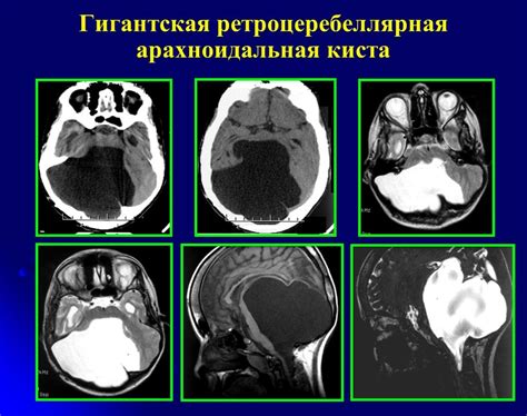 Исследования арахноидальных пространств: