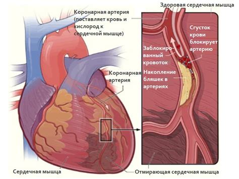 Ишемическая болезнь сердца: причины и пути профилактики