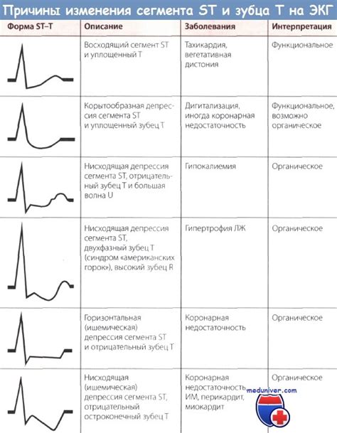 Ишемия сердца и депрессия сегмента ST