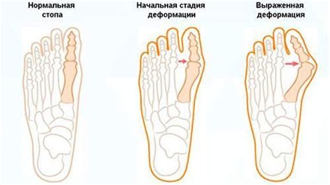 Какая обувь может вызвать боль на ноге?