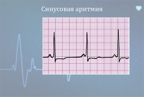 Какие бывают причины синусовой аритмии