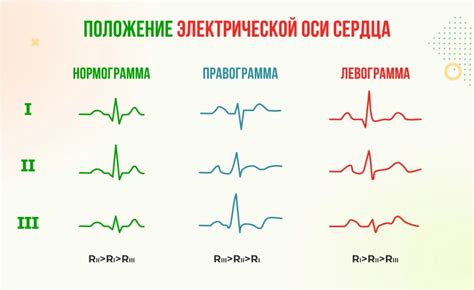 Какие заболевания могут быть выявлены при ЭКГ вертикального положения ЭОС у ребенка?