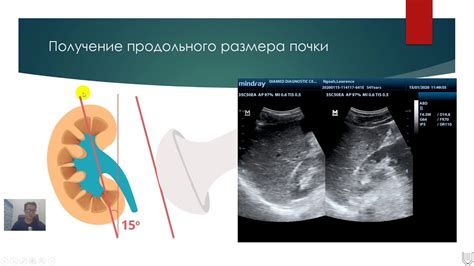 Какие заболевания могут быть связаны с нечеткими контурами почек на УЗИ?