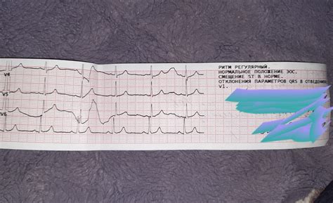 Какие заболевания могут быть связаны с отклонением параметров QRS в отведении aVR?