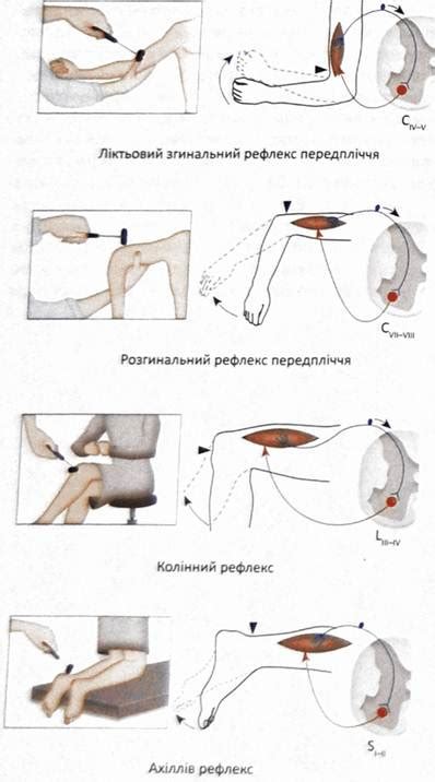 Какие заболевания могут вызывать повышенные сухожильные рефлексы?