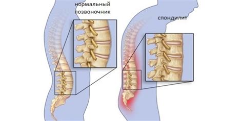 Какие последствия приносит кифозирование поясничного отдела?