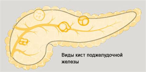 Какие причины возникновения псевдокисты поджелудочной железы?