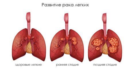 Какие причины вызывают липому легких