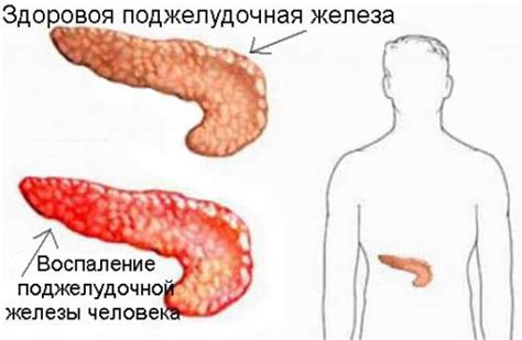 Какие проблемы возникают при недифференцировании панкреатического протока?