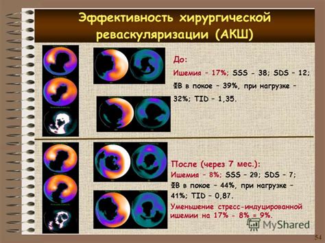 Какие пути лечения при изменении ФВ 41%?