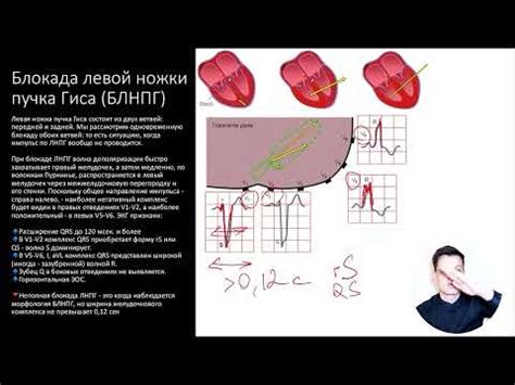 Какие симптомы возникают при нарушении внутрижелудочковой проходимости?