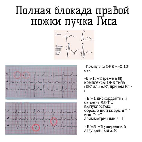 Какие симптомы встречаются при неполной блокаде правой ножки пучка Гиса?