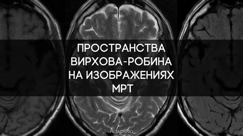 Какие симптомы могут указывать на наличие расширенных пространств Вирхова-Робин?