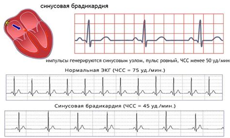 Какие симптомы наблюдаются при тяжелой брадикардии?