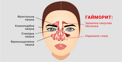 Какие симптомы свидетельствуют о наличии гайморита?
