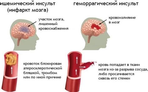 Какие симптомы свидетельствуют о наступлении инсульта?