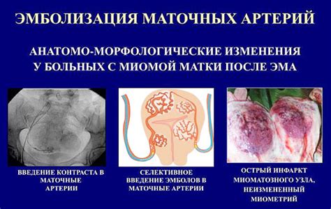 Какие симптомы свидетельствуют о рождающемся миоматозном узле?