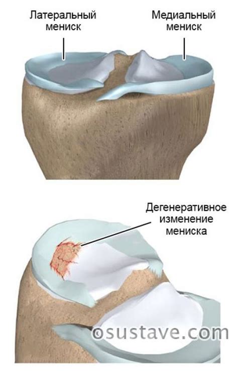 Какие симптомы свойственны повреждению медиального мениска 3 степени?