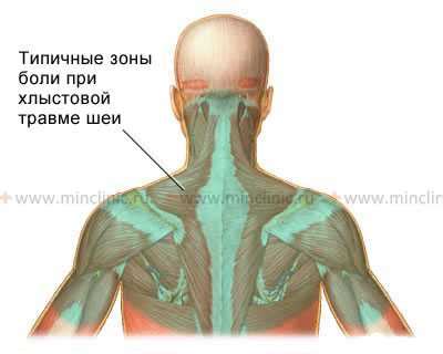 Какие симптомы свойственны хлыстовой травме шеи?