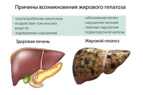 Какие симптомы сопровождают гепатоз и стеатоз печени