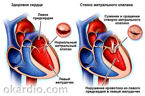 Какие симптомы сопровождают гипертрофию левого предсердия?