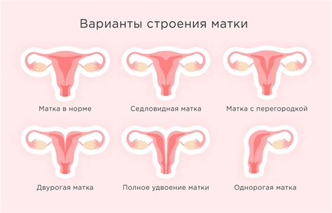 Какие симптомы сопровождают гипоплазию матки?