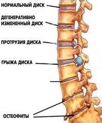 Какие симптомы сопровождают межпозвонковую грыжу?